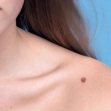 Anyajegy eltávolítás